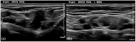 Symptomatic Recurrent Varicose Veins Due To Primary Avalvular Varicose