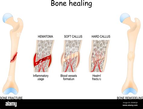 Bone Healing Process After A Bone Fracture Stages Of Bone Healing