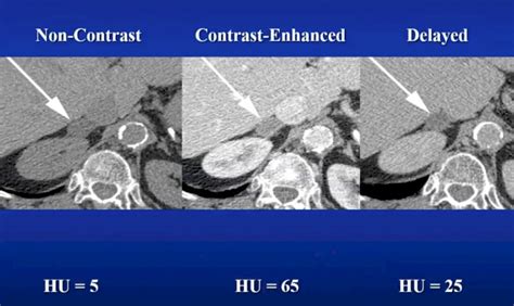 Adrenal Lesions Ct Hot Sex Picture