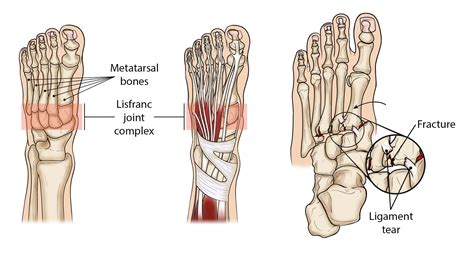 Lisfranc Fracture Motus Physical Therapy