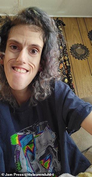 Woman With Condition Which Causes Facial Deformities Claps Back At