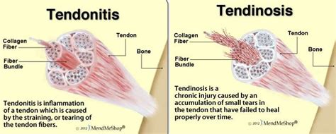 What Is The Difference Between Tendinits And Tendinosis In Runners