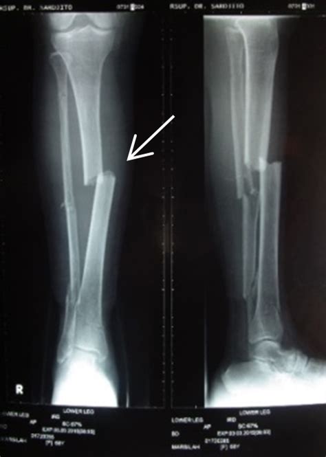 Orthopaedi Knowledges: MANAGEMENT OF LONG BONE FRACTURES