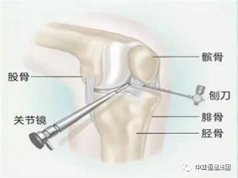 关于关节镜和膝关节镜手术你了解吗？诊断