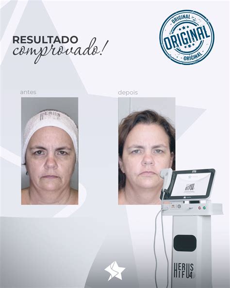 Tratamentos Tratamentos Faciais Ultrassom Microfocado Depila Laser