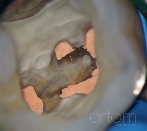 Повторне ендодонтичне лікування зубів - Ortom lounge dental clinic