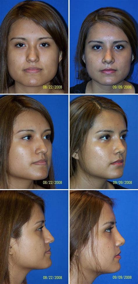 Rhinoplasty Nose Surgery Before And After Photos Miami Plastic Surgery