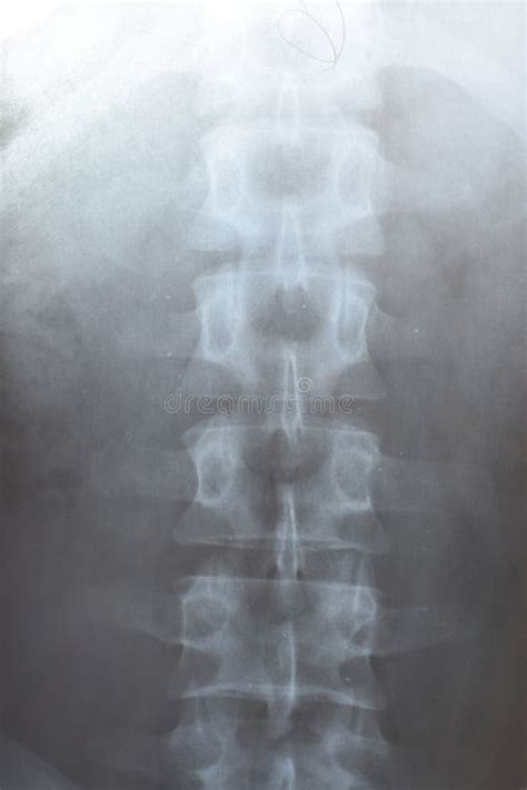 X Ray of the Lumbar Spine, Spine on X-ray Stock Image - Image of magnetic, negative: 154424255