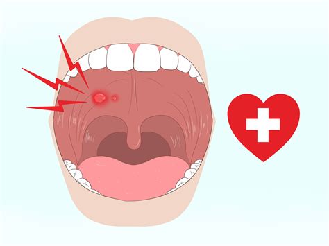 3 Ways to Get Rid of Mouth Blisters - wikiHow