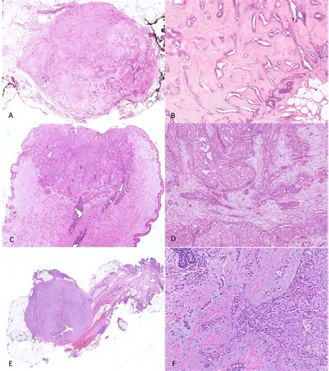 Significance Of Adenosquamous Proliferation In Breast Lesions Journal