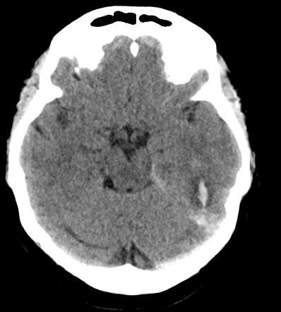 Dural Venous Thrombosis