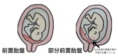 前置胎盤や低置胎盤と診断されたら？妊娠中の注意点や出産準備・出産方法について解説！ あなただけの Only One 助産師