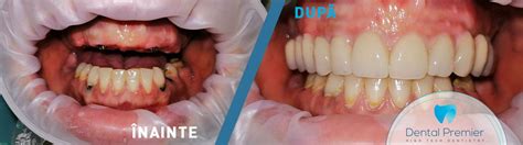 Fotografii Cazuri Clinice Implant Dentar Fast And Fixed Bredent