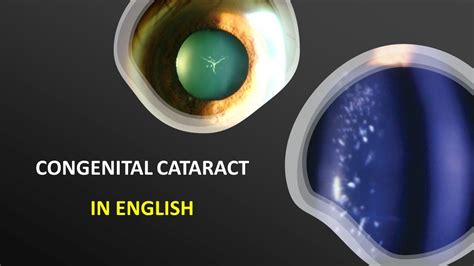 Congenital Cataract Developmental Cataract In English Youtube