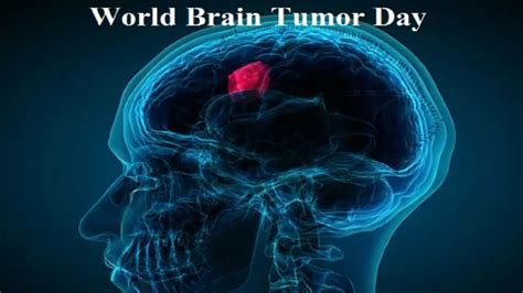 World Brain Tumor Day 2023 Know Theme History Significance And Facts