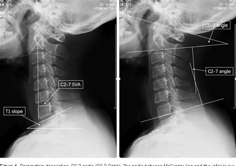 Figure 1 From Changes Of Cervical Sagittal Balance Parameters After