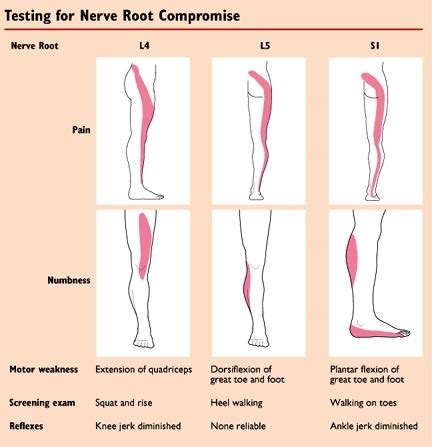 17 Best images about Back pain on Pinterest | Cauda equina syndrome, Back pain and The nerve