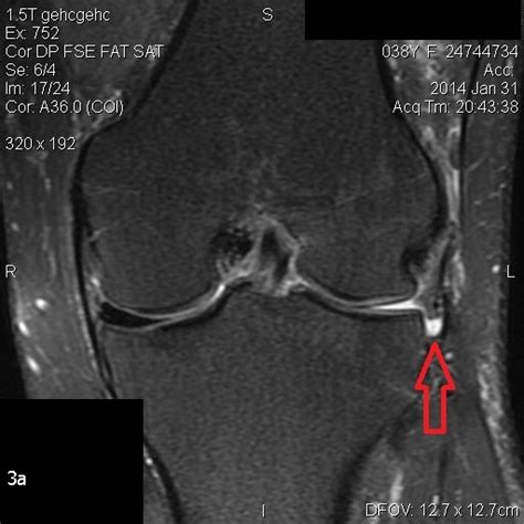 Lesiones Meniscales En Mri