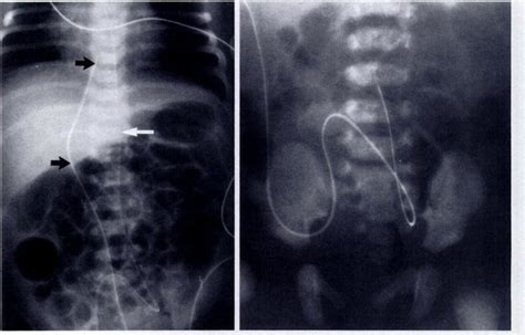 A Radiograph Of The Lower Chest And Abdomen Shows An Umbilical Venous