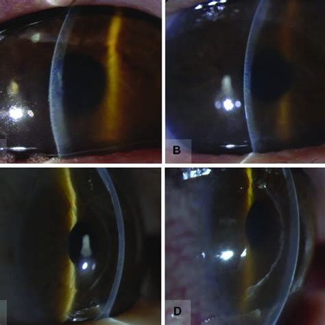 Indications For Repeat Descemet Membrane Endothelial Keratoplasty Download Scientific Diagram