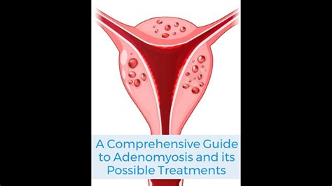 A Guide To Adenomyosis And Possible Treatments Youtube