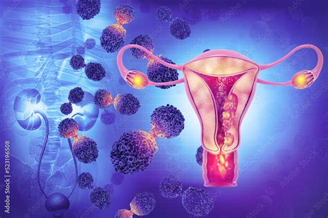 Female Reproductive System Diseases Uterus Cancer And Endometrial