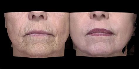 Laser Skin Resurfacing Pasadena Los Angeles Ca