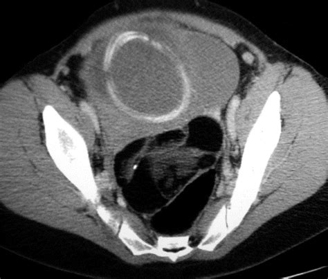 Laparoscopic Management Of A Ruptured Benign Dermoid Cyst During