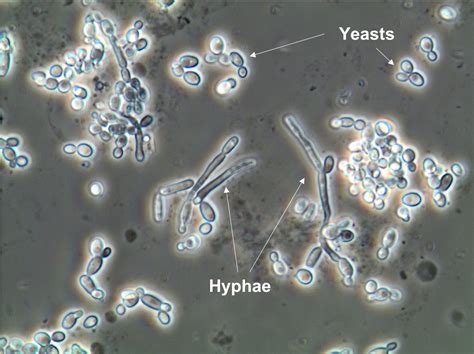 Urine Sediment Of The Month Microorganisms Renal Fellow Network