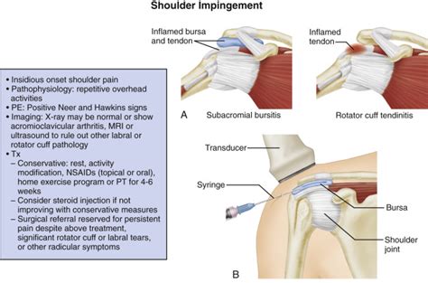 Subacromial Shoulder Impingement Syndrome 59 Off