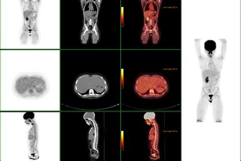 PET/CT SCANNER | River Radiology