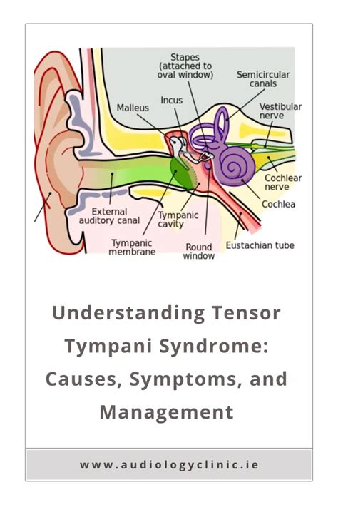 Ppt Understanding Tensor Tympani Syndrome Causes Symptoms And