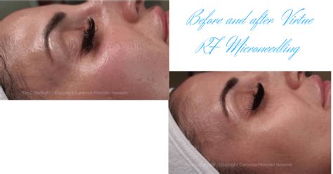 Virtue Rf Microneedling Skin Rejuvenation For All Skin Tones