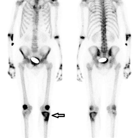 Pdf Pancreatitis Panniculitis And Polyarthritis Ppp Syndrome Caused By Post Pancreatitis