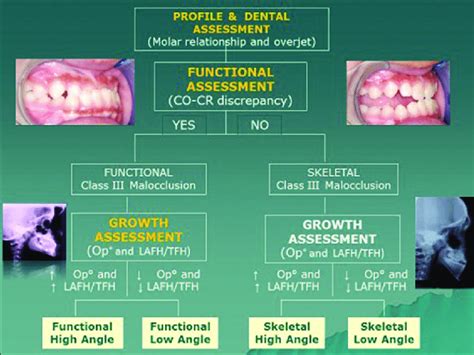 Classification Of Developing Class Iii Malocclusion For Early Download Scientific Diagram