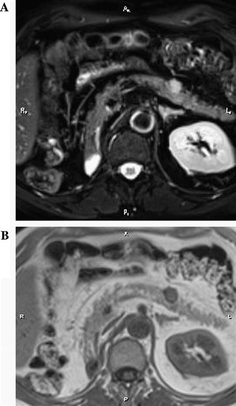 A And B T2 Weighted With Fat Saturation Image Fig 1a And T1 Download Scientific Diagram