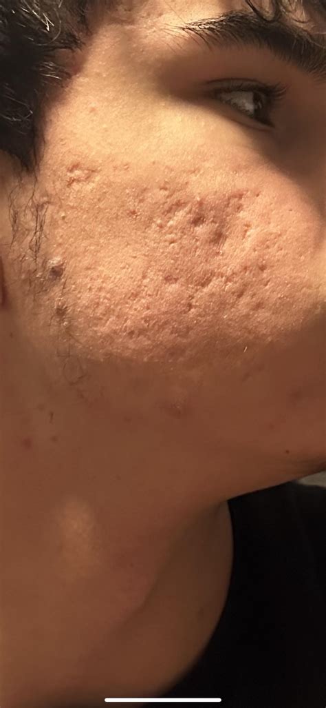 what can I do about these acne scars? : r/acne