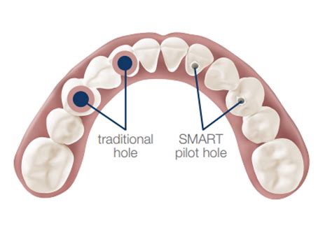 Smart Denture Conversion Quincy Ma South Shore Oral Surgery Associates