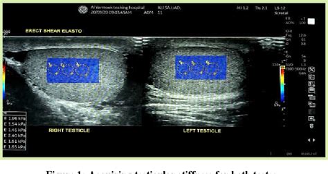 Figure From Varicoceles By Shear Wave Elastography Evaluation Of The