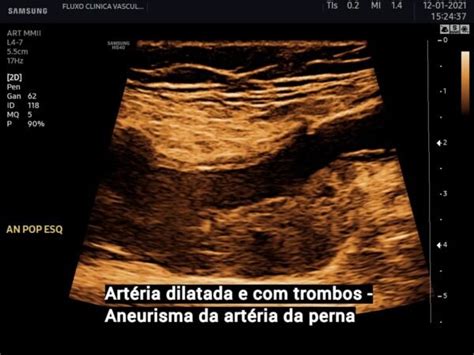 Doppler Arterial Dos Membros Inferiores Saiba Mais