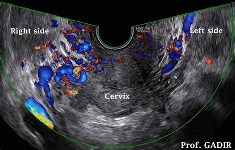 Pelvic Congestion