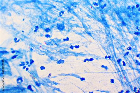 Mycobacterium Tuberculosis Positive Small Red Rod In Sputum Smear Acid Fast Stain Analyze By