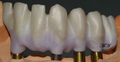 Zirkon Gingiva Dentalligent Blog