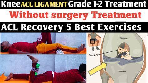 Treatment Of Acl Injury Partial Tear Grade1 2 Aclrehab Exercises