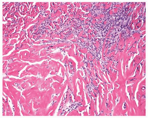 Diffuse Alveolar Septal Amyloidosis Basicmedical Key