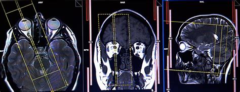 Mri Protocols Orbit Mri Planning Referral Lines Mri Orbit Techniques