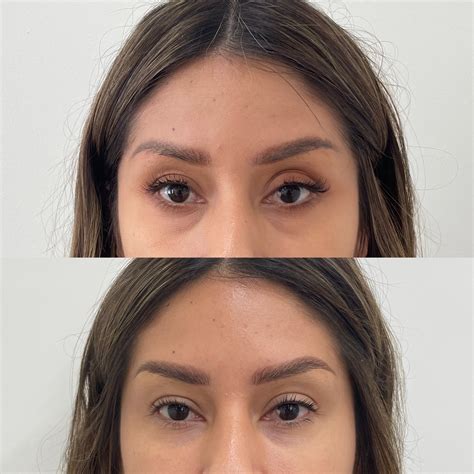 Eye Filler Real Patient Photos And What To Expect