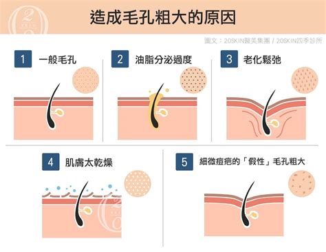 【毛孔粗大】毛孔出油又粗大 除了皮秒雷射你需要知道的更多 台中 二林四季皮膚科 20skin美醫集團