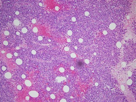 Angiosarcoma Histology - Pathology Outlines Angiosarcoma - checkmatechards