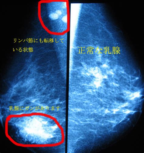 乳がん健診について フィオーレ第一病院